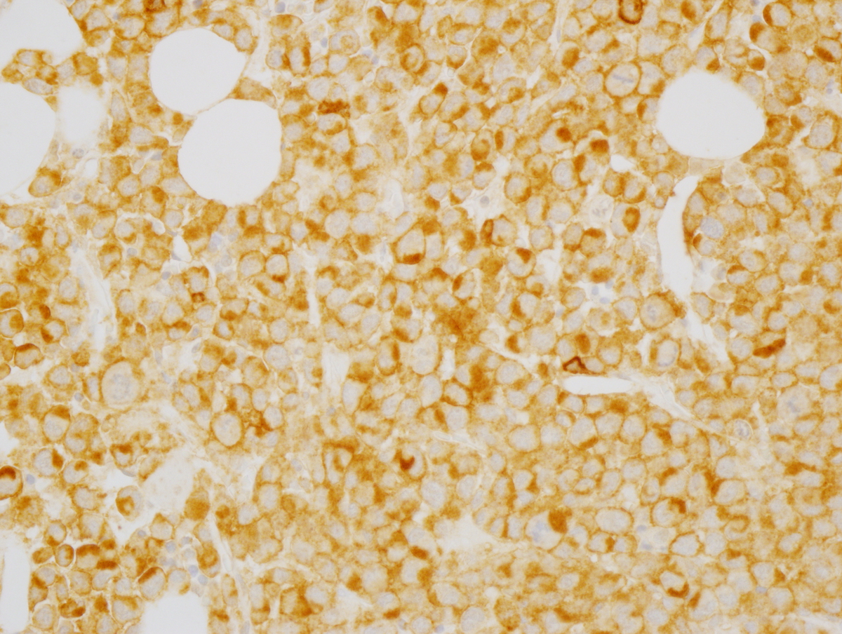 Fig. 8 Bone marrow core biopsy. By immunohistochemistry the cells expressed CD45, CD33 (Fig. 8a), muramidase (Fig. 8b), CD99 (Fig. 8c), and focal weak CD68 (Fig. 8d). CD34, CD117 and myeloperoxidase were negative.